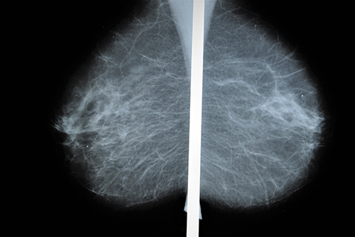 mammogram